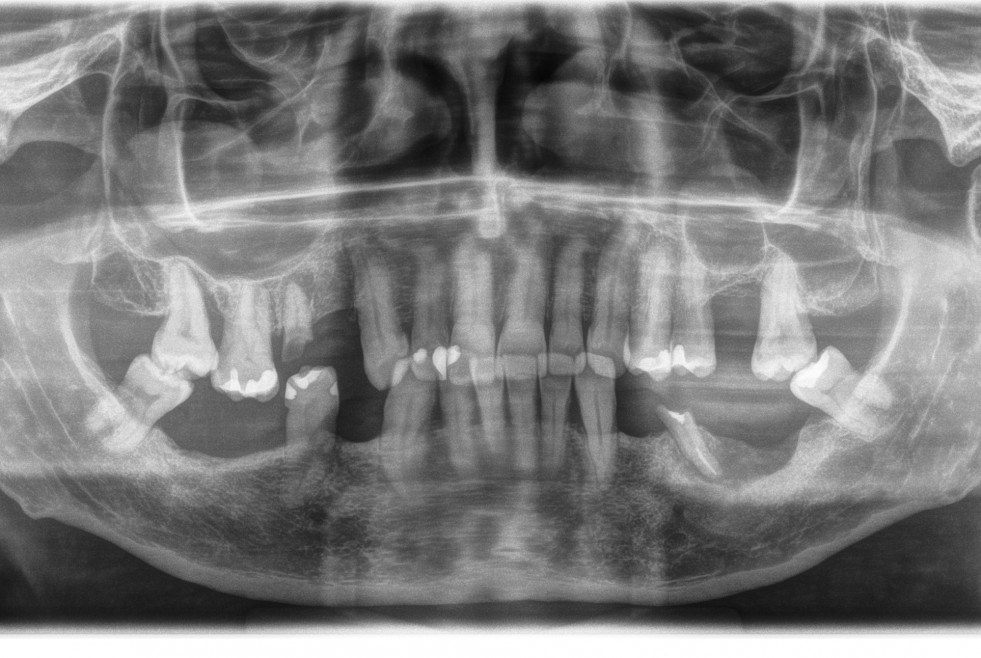 figura 3_caso_anitua_implantología_DM57