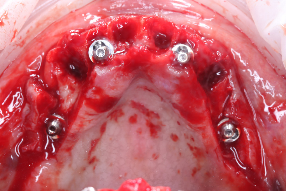 Imagen 8 caso implantologia Nobel Biocare DM 81