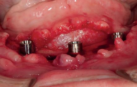 Caso 1. Imagen 6. Implantes Trefoil colocados.