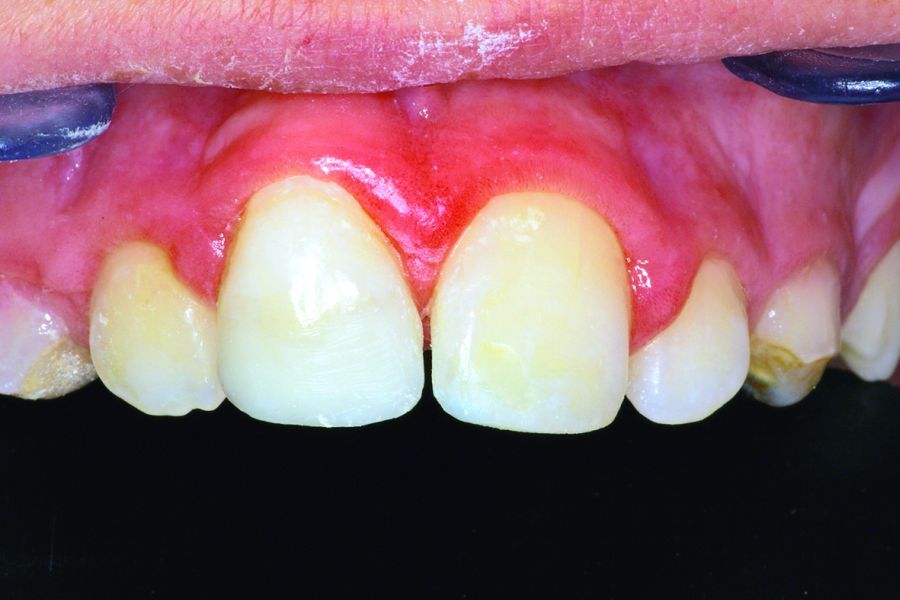 8. A los dos meses del autotransplante, se prepara el diente y se utiliza composite para mejorar el aspecto estético.