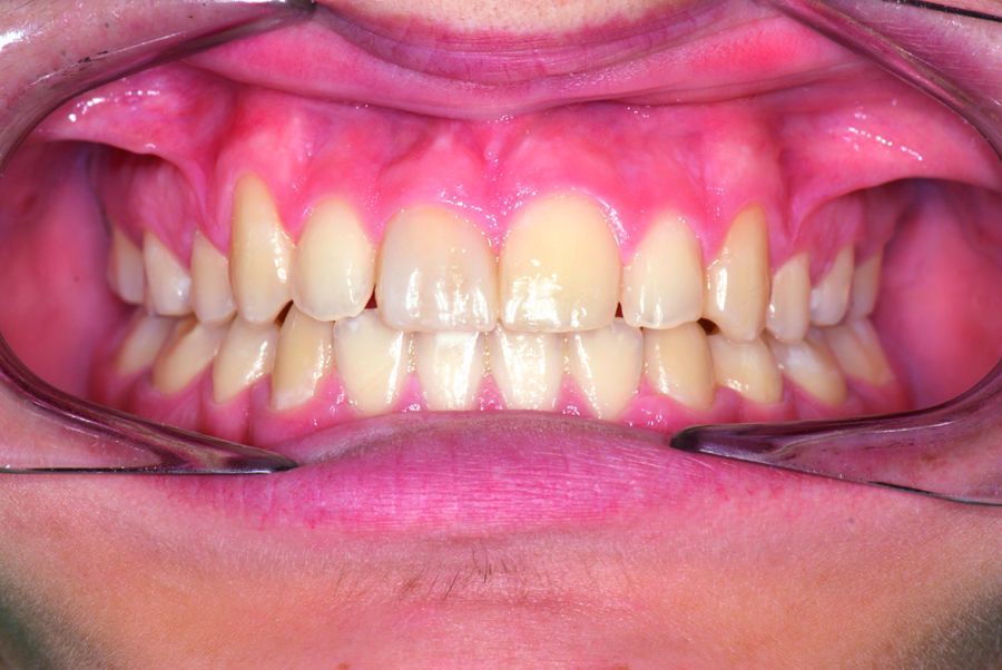 11. Aspecto vestibular a los 10 años. El diente autotransplantado es ligeramente más estrecho y el cénit está ligeramente más bajo. De cara a conseguir un mejor resultado estético podría ser recomendable un recontorneado gingival y carillas tras completarse el crecimiento del paciente.
