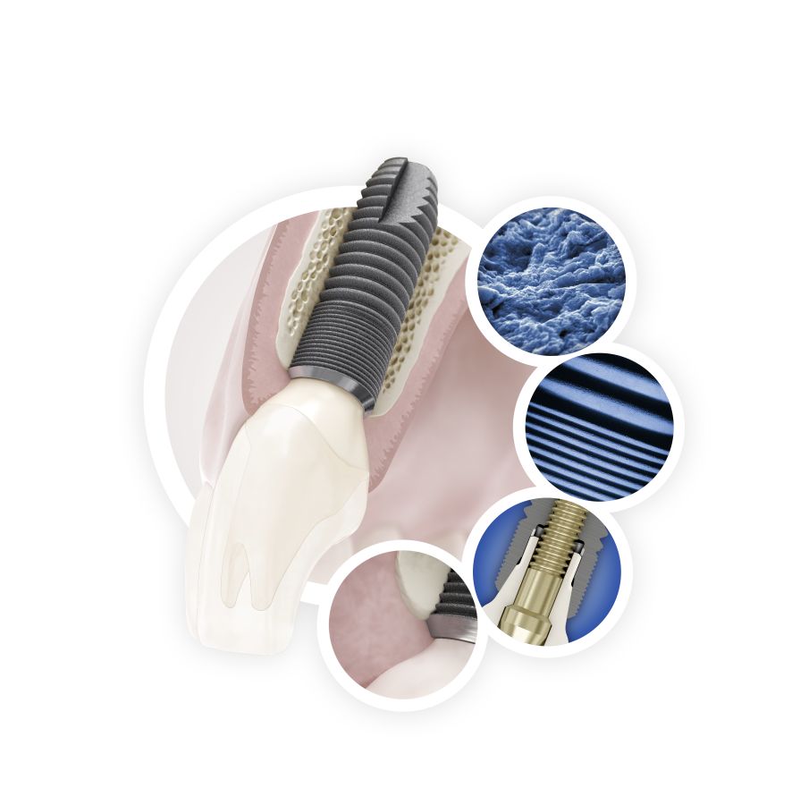 ASTRA TECH Implant System EV BioManagement Complex_