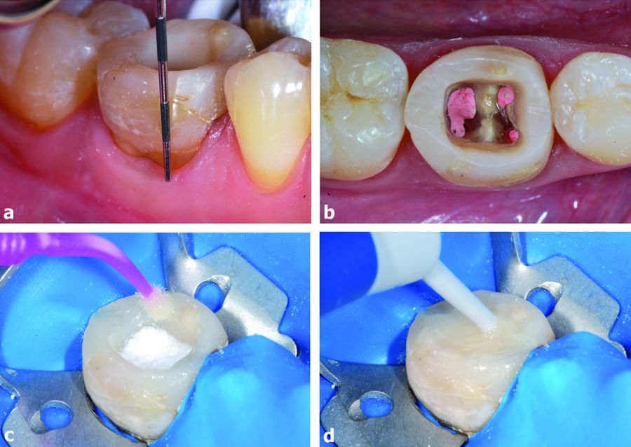 4. Tooth bleaching before the treatment.