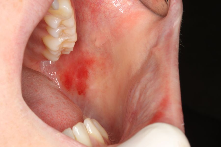 Candidiasis eritematosa en un paciente con boca seca.
