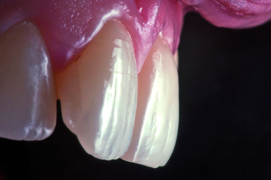 Imagen obtenida con iluminación indirecta que muestra los volúmenes dentales, la macroanatomía de la superficie dental así como la consistencia de los márgenes gingivales. Se aprecia, por ejemplo, como la grieta en el lado distal del incisivo central de la derecha influye en la transmisión de la luz, haciendo más oscura la parte palatal de la pieza.