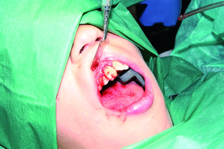 3. Posicionamiento inicial del premolar mandibular en el lecho del incisivo, para comprobar la adaptación.