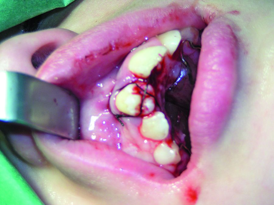 5. Se utiliza una sutura para fijar el diente en posición