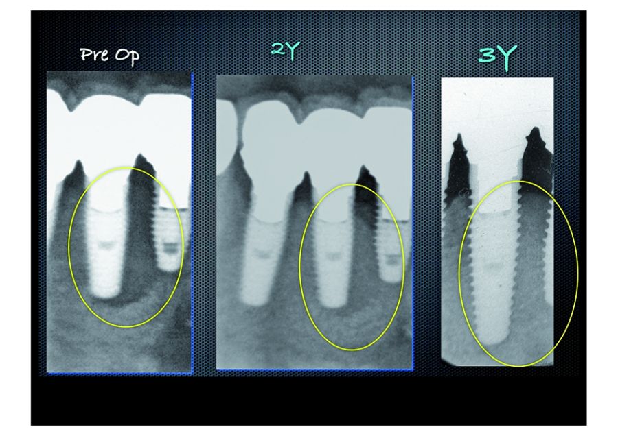 This x-ray was taken 2 years and 3 years after the treatment showing stabilized bone growth.