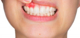 encías_salud_periodontal_DM64