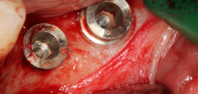 Fig. 1. k) Implantes colocados.