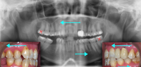 Fig. 7. Dirección de los movimientos planificados para cada arcada y hemiarcada. Extracciones seleccionadas.