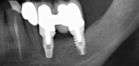 Figura 7. Realización de rehabilitación definitiva sobre implantes una vez integrado el segundo implante colocado sobre la zona regenerada con el injerto en bloque.