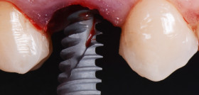 en España se colocan entre 1.200.000 y 1.400.000 millones de implantes dentales al año