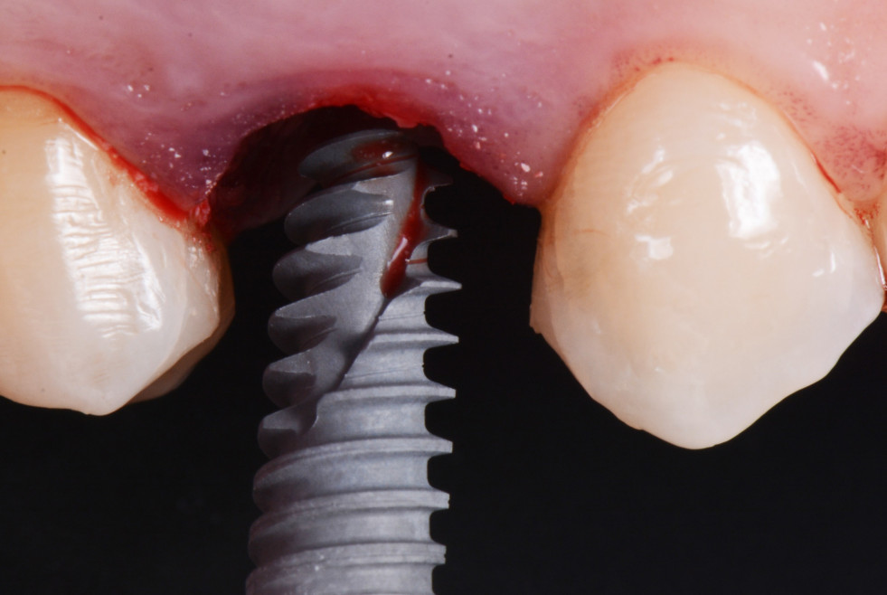 en España se colocan entre 1.200.000 y 1.400.000 millones de implantes dentales al año