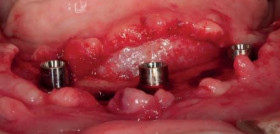 Caso 1. Imagen 6. Implantes Trefoil colocados.