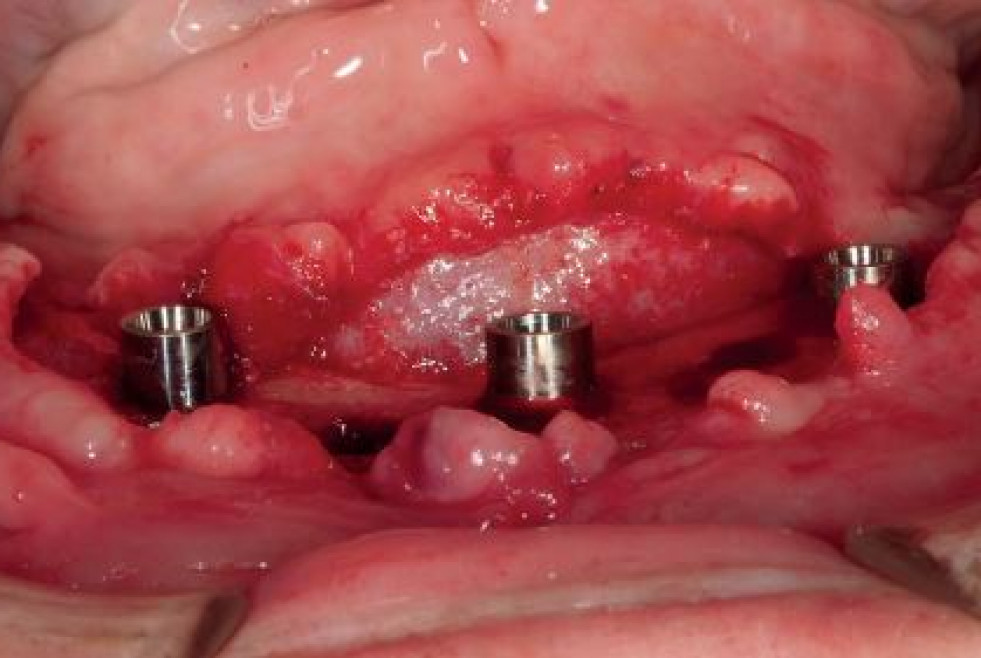 Caso 1. Imagen 6. Implantes Trefoil colocados.