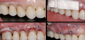 Utilización de matrices colágenas en cirugía mucogingival Dr. Erik Regidor