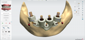 3Shape Implant Studio 2020 Bone supported guide