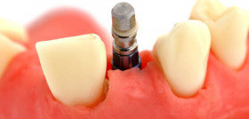 En España se colocan entre 1.200.000 y 1.400.000 millones de implantes dentales al año.