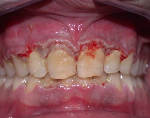 Paciente con periodontitis ulcerativa.