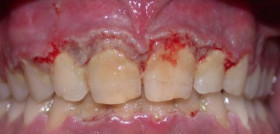 Paciente con periodontitis ulcerativa.