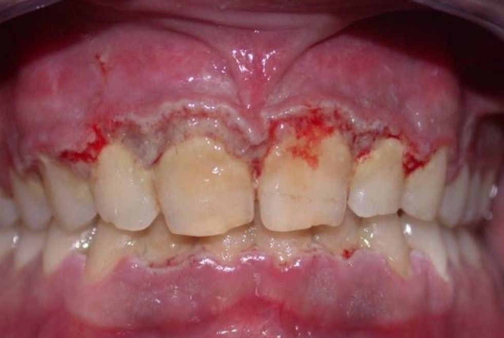 Paciente con periodontitis ulcerativa.