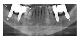 Figura2_CasoAnitua_implantología_DM53