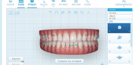 caso_ortodoncia_digital_Invisalign_DM54