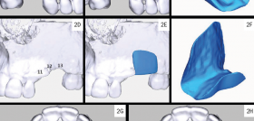 caso_implantología_alogenicos__DRBLUME_DM54