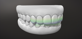 G8_INVISALIGN