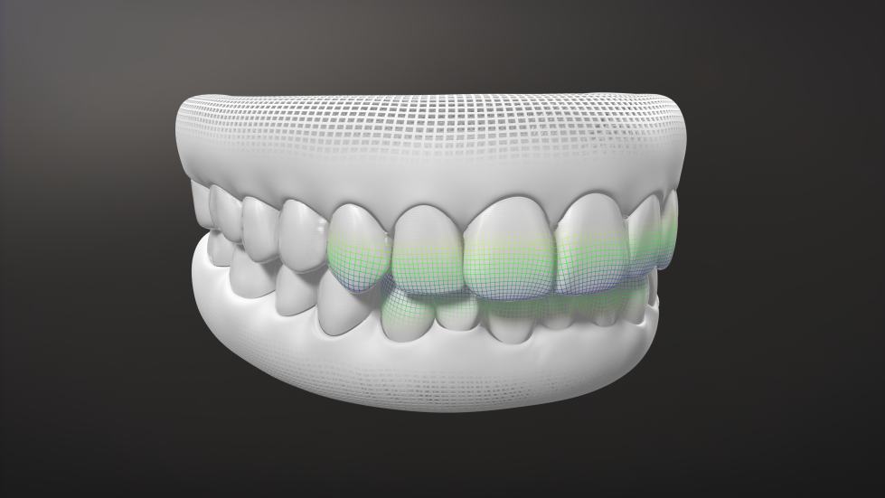 G8_INVISALIGN