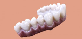 Puente de zirconia NobelProcera sobre implantes