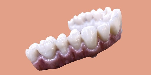 Puente de zirconia NobelProcera sobre implantes