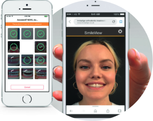 invisalign go_align technology