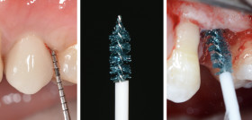 Figura8_CasoImplantología_DM57_Descontaminación_implantes_Dr.Regidor
