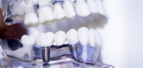 Dentists dental teeth implant_123RF