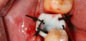 caso_cirugía_maxilofacial_DM61