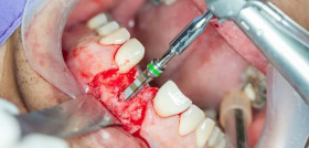 Dental implants surgery in real patient
