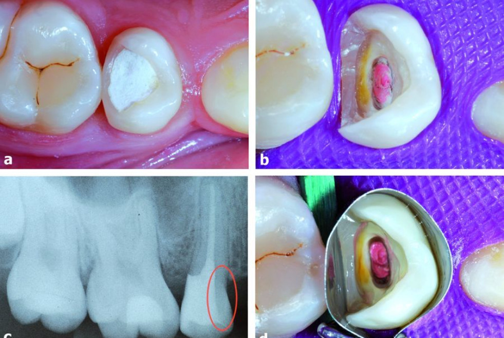 Imagen inicial del diente 15 desvitalizado