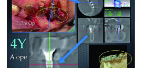 These are a CT scan and volume rendered image made 4 years after treatment.