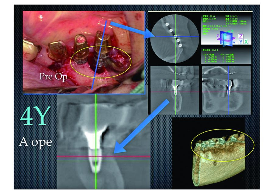 These are a CT scan and volume rendered image made 4 years after treatment.