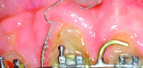 Inserción del minitornillo en la mucosa alveolar