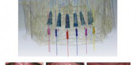 Implantología Oral Guiada