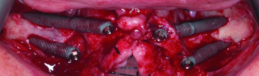 Rescate de periimplantitis con quad