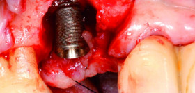 PeridonciaImplantologia_DM5_ EduardoAnitua