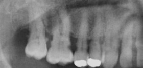 CARIES (1)