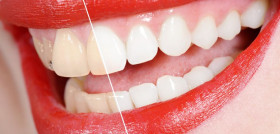 123rf-before and after the tooth whitening