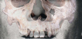 visión de dientes antemortem
