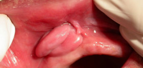 Epifulis