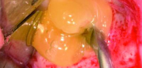 DM13_endodoncia